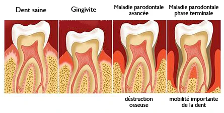 maladies des gencives