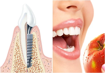 les avantages des implants dentaires