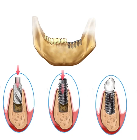 les avantages des implants dentaires