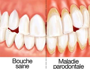 parodontite