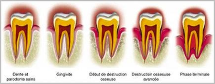 recession gingivale